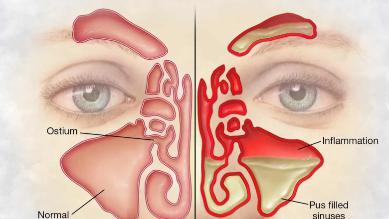 How to Get Rid of a Sinus Infection in 24 Hours: Fast & Natural Remedies That Work