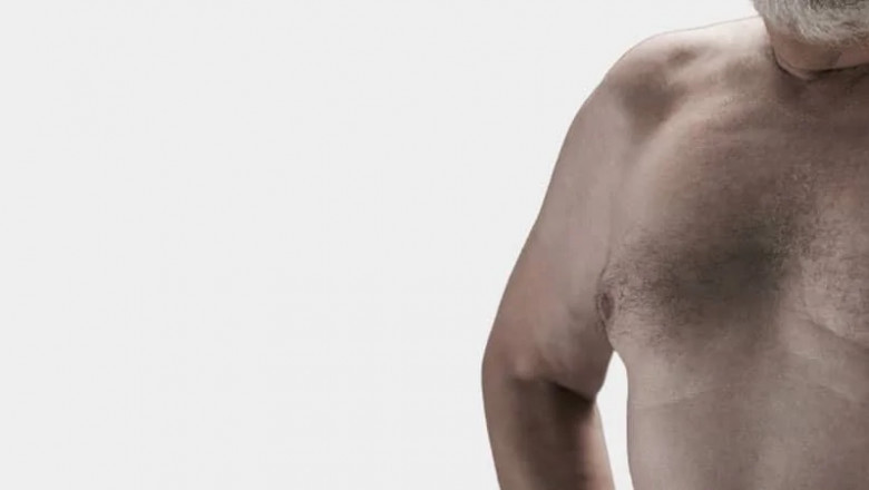 Considering gynecomastia surgery? Here are 5 things that you should know