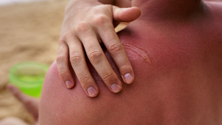 Revolutionizing Keloid Treatment: Future Insights and Market Dynamics by DelveInsight