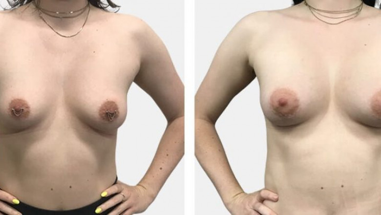 Fat Transfer Breast Augmentation Sydney - Breast & Body Clinic