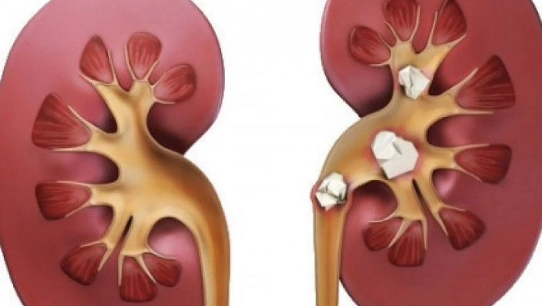 Exploring Ayurvedic Treatment For Kidney Stone: Ancient Solutions for Pain-Free Living