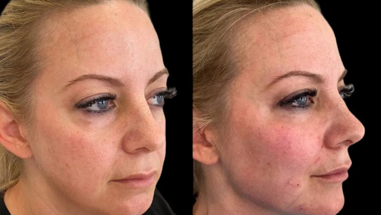 Why the Best Plastic Surgeons in Dubai Are Experts in Providing Natural-Looking Cheek Fillers