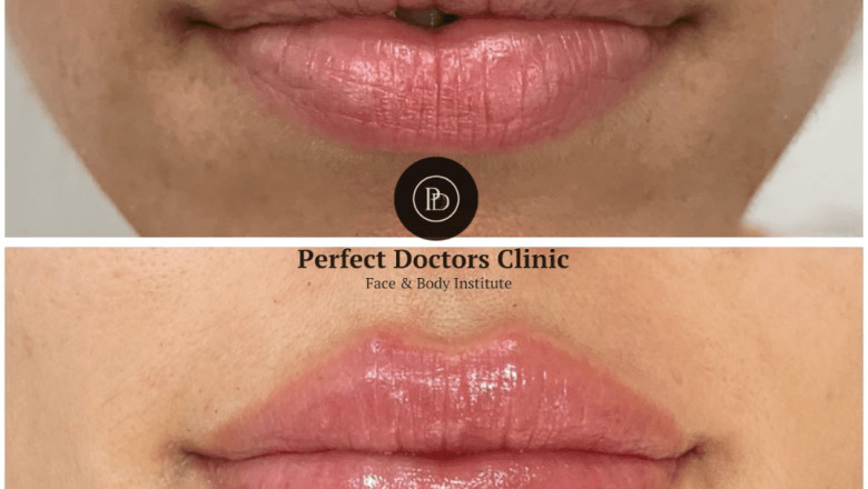 Understanding Juvederm’s Effectiveness for Wrinkle Treatment: Expert Insights from the Best Plastic Surgeon in dubai