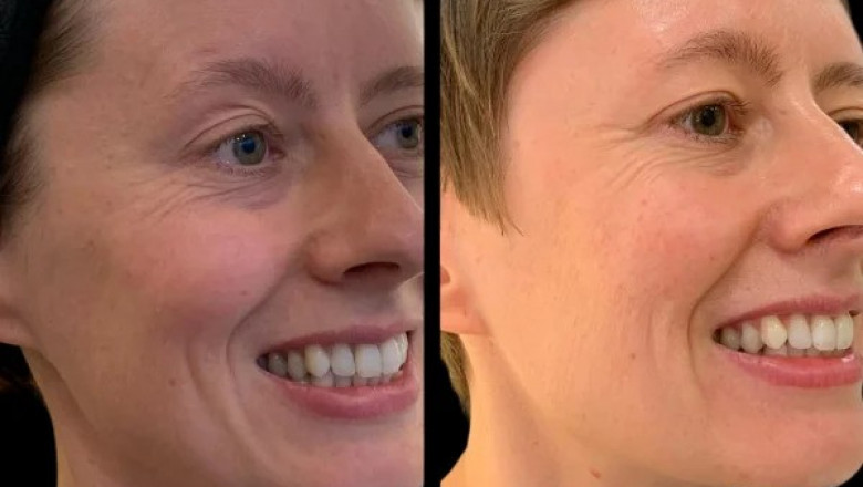 What to Expect When Visiting the Best Doctors in Dubai for Profhilo Treatment
