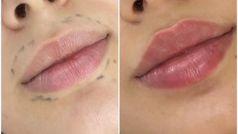 How to Choose the Right Juvederm: Best Doctors in dubai Advice