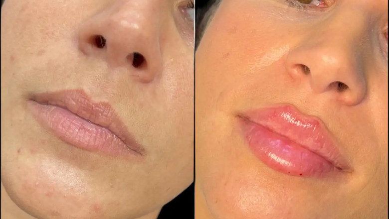 How to Prepare for Fillers in Dubai: Pre-Treatment Tips
