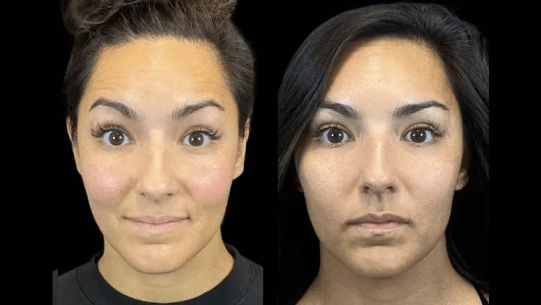 Natural Results with Botox in Dubai: How Experts Do It