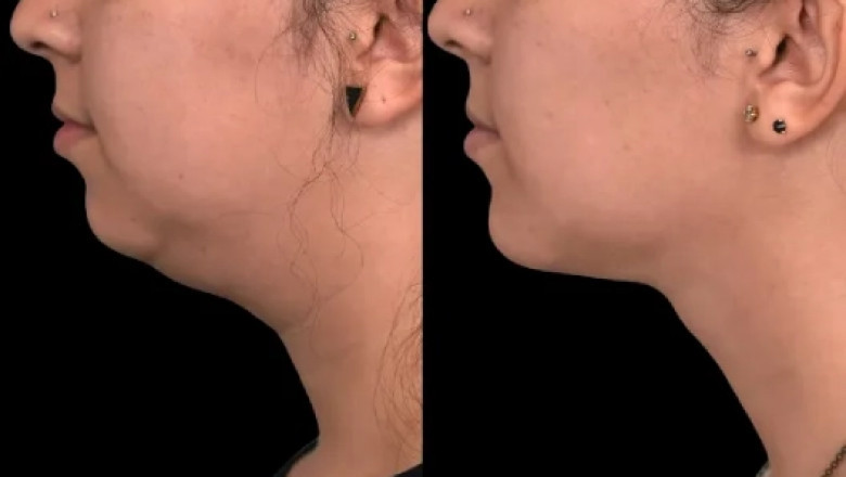 The Latest Techniques in Double Chin Removal by the Best Doctors in Dubai