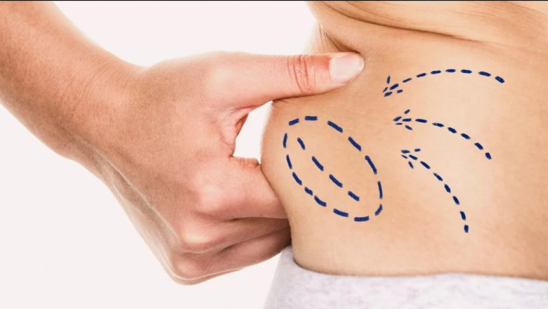 Rest Recover and Rejuvenate Preparing for Liposuction Recovery in Dubai