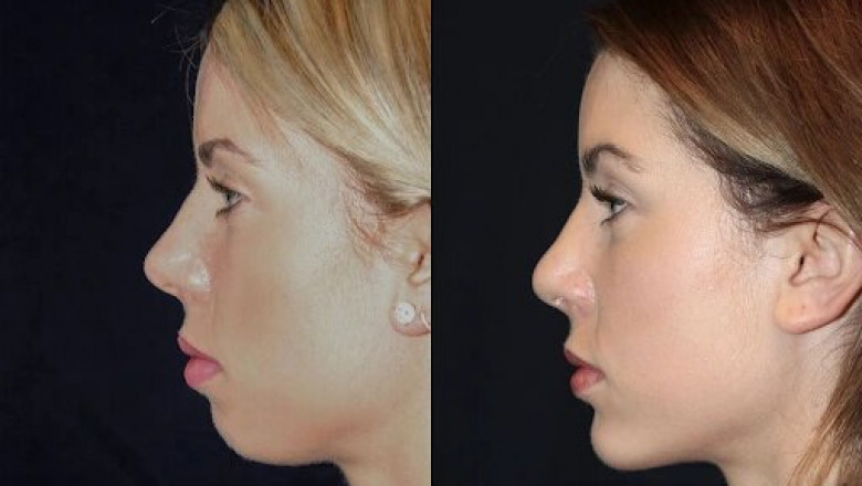 Best Doctors in dubai Explain How Chin Fillers Improve Facial Balance