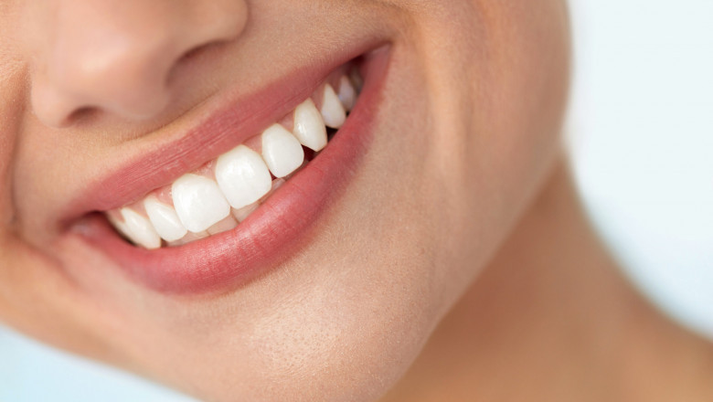 How to Care for Your Veneers Dubai for Long-Lasting Results
