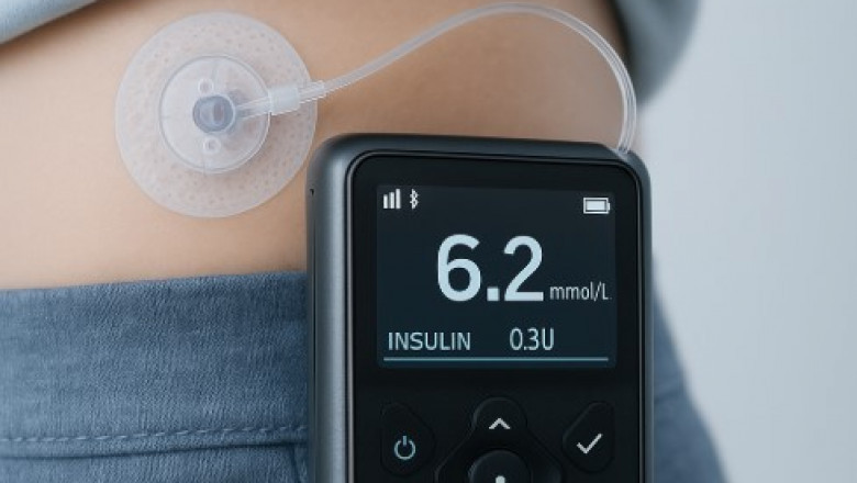Welcome to Aidex CGM: Revolutionizing Diabetes Care with Automatic Pumps for Insulin Dependent Patients
