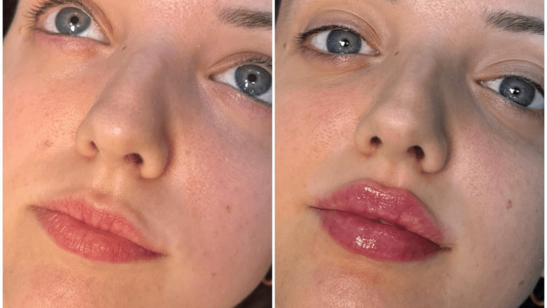 Juvederm Lip Fillers: Best Aesthetic Clinics in dubai to Visit