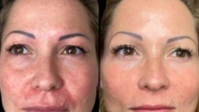 Best Plastic Surgeon in Dubai: The Long-Term Results of Profhilo Treatment