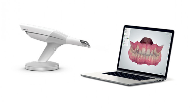 Advancing Dentistry with Intraoral Scanners and Implants