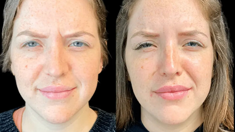 From Consultation to Results: Botox Journey with the Best Doctors in dubai