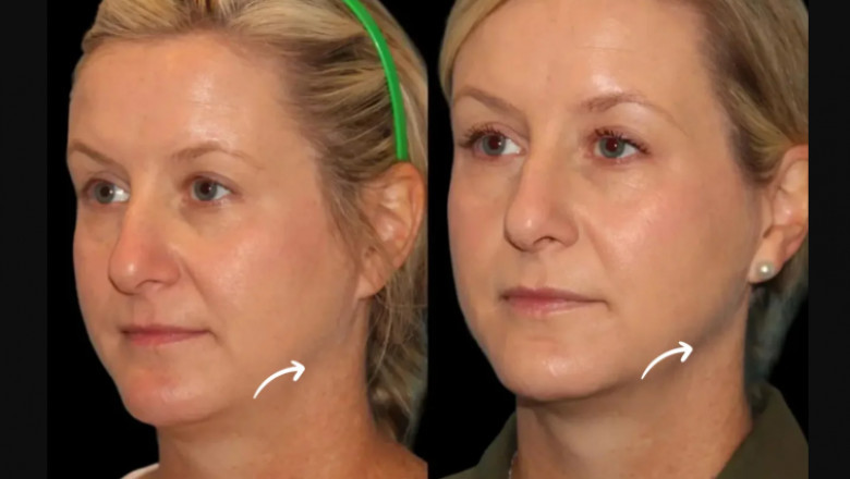 Youthful, Lifted Skin: Your Guide to the Best Doctors in Dubai for Sculptra Fillers