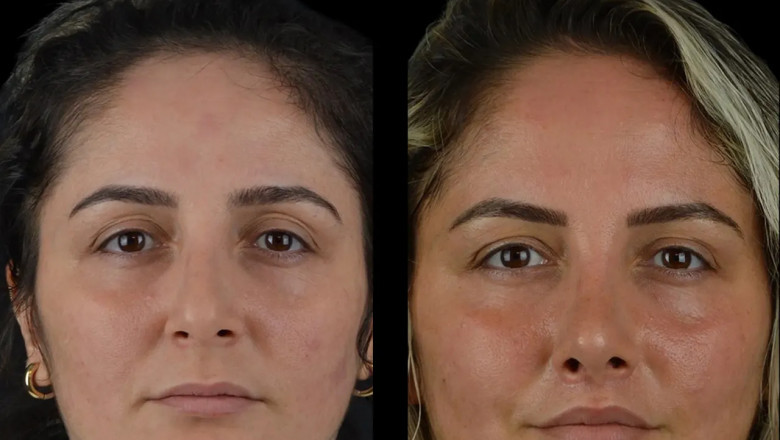 How the Best Plastic Surgeon in Dubai Customizes Cheek Fillers Treatments for Each Patient