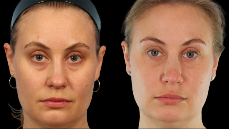 What Are the Signs That You Need Under Eye Fillers from the Best Plastic Surgeon in Dubai?