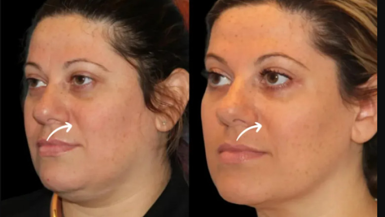 What Sets the Best Plastic Surgeon in Dubai Apart for Sculptra Fillers Treatments?
