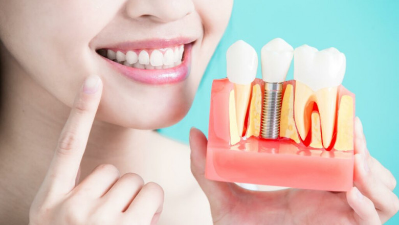 Why Dental Implants Abroad Are a Smart Choice for Your Smile