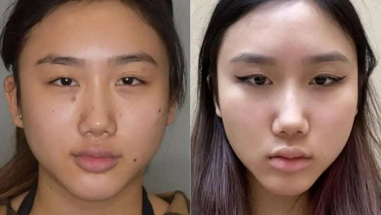 Best Age to Consider Buccal fat removal in Dubai