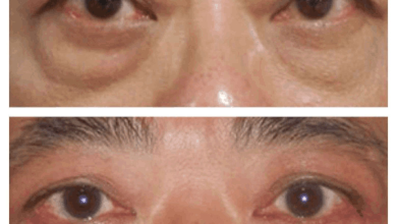 Can I wear glasses after Eye bag removal in Dubai?