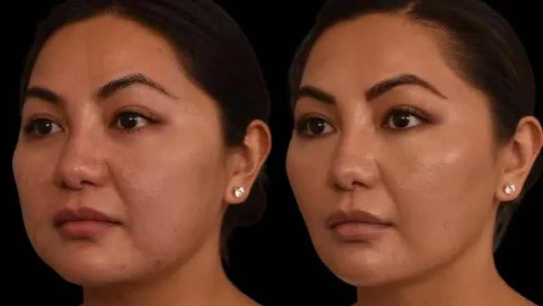 Combining Diet Plans with Double chin removal in Dubai