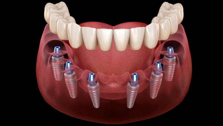 Descubre los Beneficios de las Carillas Dentales en Albania