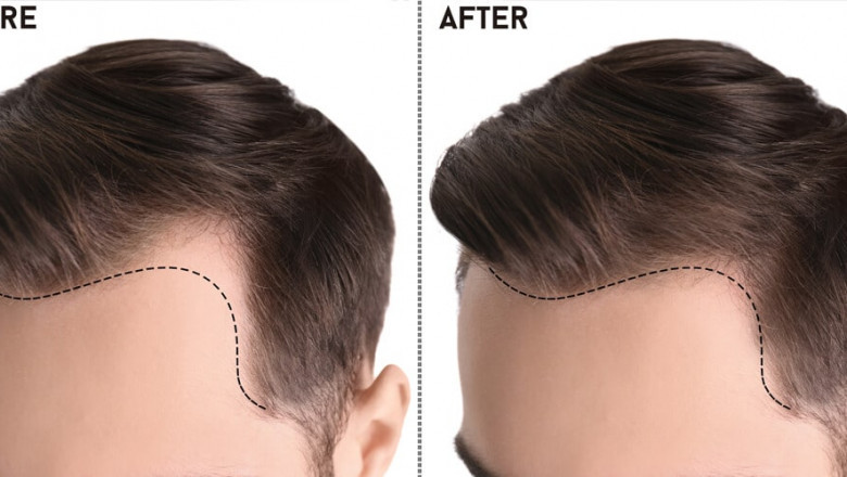 Restoring Confidence: A Comprehensive Guide to Hair Transplants in Pakistan