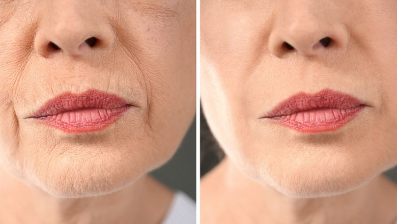 Best Doctors in Dubai for Profhilo Injections: What to Look for in a Provider