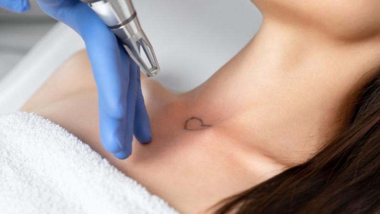 Tattoo Removal for Brides and Grooms: Starting Fresh Before the Big Day