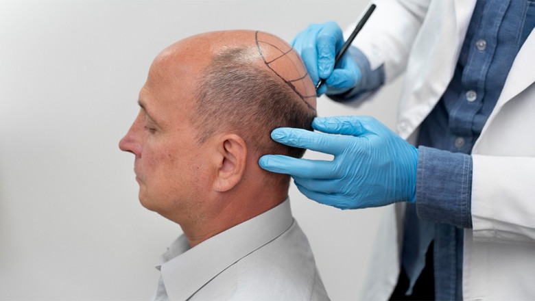 Regain Your Confidence with Advanced Hair Transplants