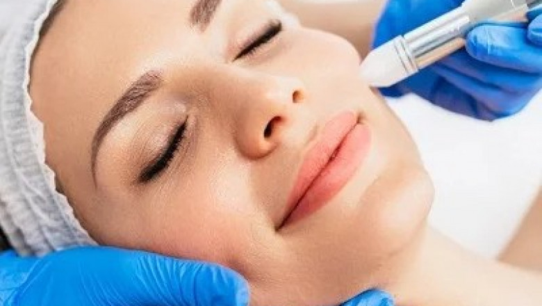Microneedling Treatment: Rejuvenate Your Skin Naturally