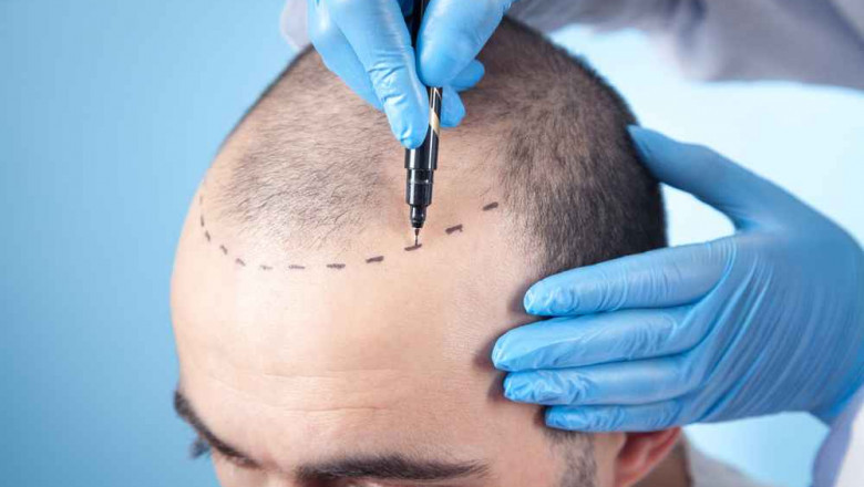 Hair Transplant Treatment