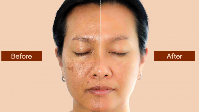 Skin Pigmentation Treatment