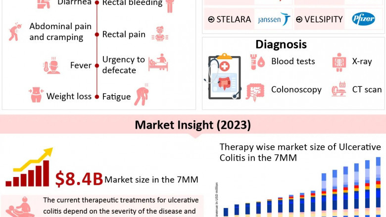Ulcerative Colitis Overview