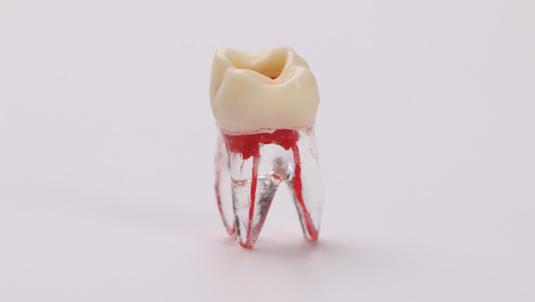 Saving Your Natural Smile: The Importance of Root Canal Therapy