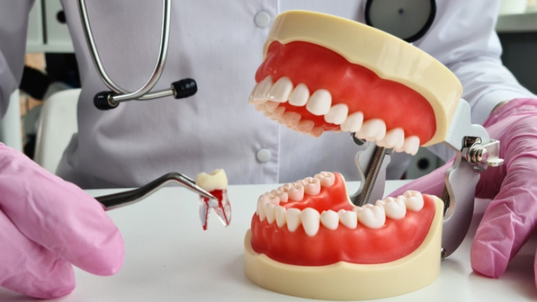Tooth Removal: When Extraction Is the Right Dental Choice