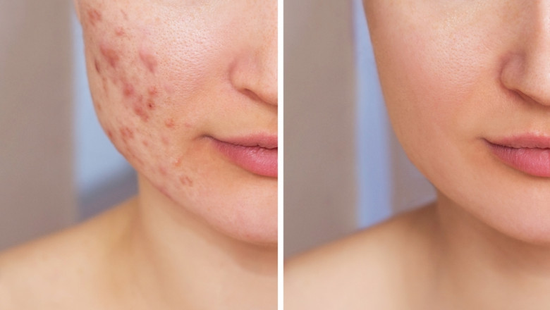 Acne Scar Treatment
