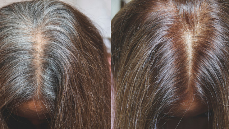Grey Hair Treatment