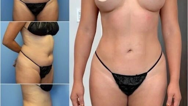 Discover the Art of Body Contouring in Dubai with Experts