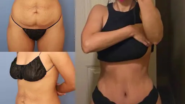 Tummy Tuck in Dubai: Why Recovery Time is Important