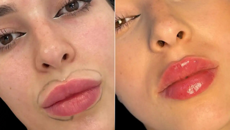 Why You Should Consider Fillers in Dubai: Key Benefits Explained
