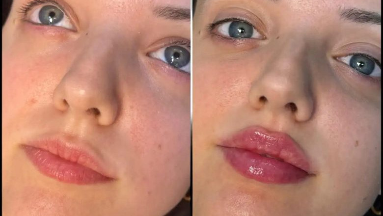 How the Best Plastic Surgeons in dubai Can Improve Your Smile with Lip Fillers