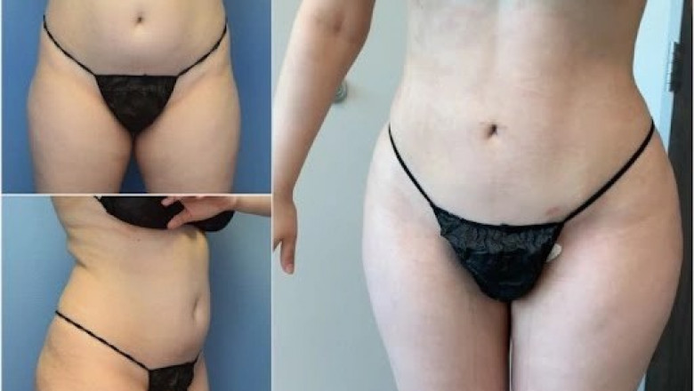 Set for Success Key Preparations Before Liposuction Surgery in Dubai