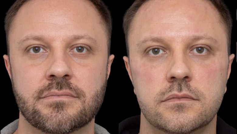 Under Eye Fillers in Dubai: How the Best Plastic Surgeons in Dubai Deliver Natural Results