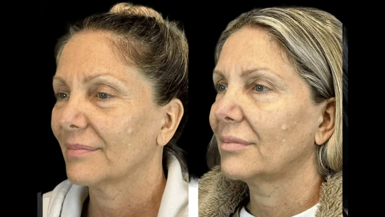 Why Celebrities Choose the Best Plastic Surgeon in dubai for Their Botox Treatments