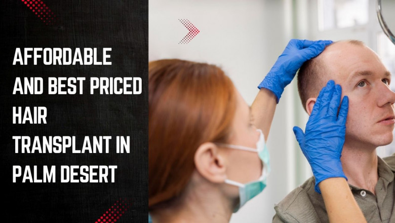 Affordable and Best Priced Hair Transplant in Palm Desert