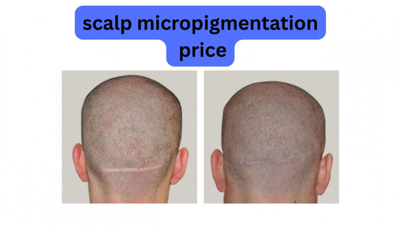 Scalp Micropigmentation Cost Guide 2025
